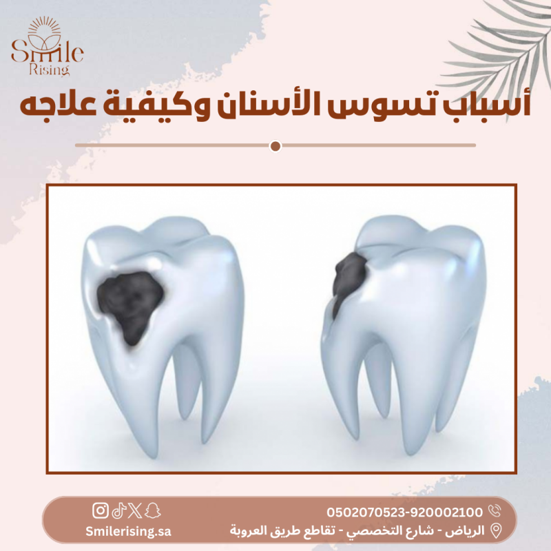 تسوس-الأسنان-3-800x800.png