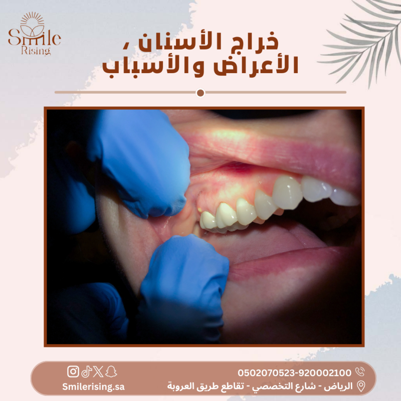 خراج-الأسنان-،-الأعراض-والأسباب-800x800.png